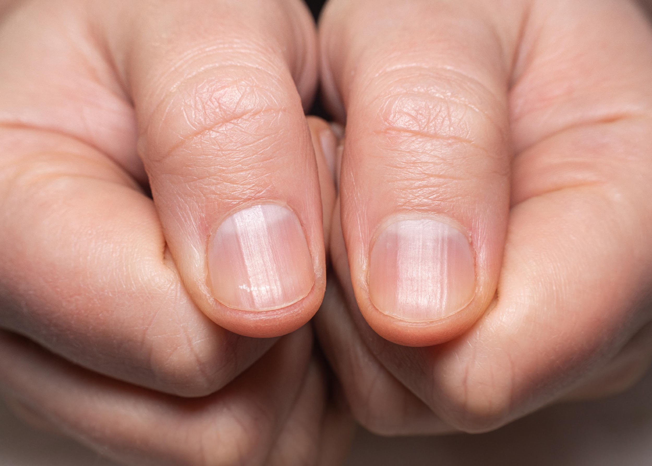 Causas síntomas y tratamientos para uñas encarnadas o uñeros